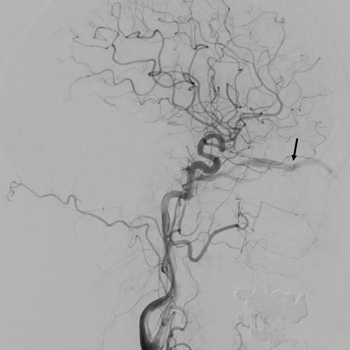 Neuroinfo Japan:硬膜動静脈瘻